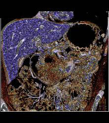 Duodenal Carcinoma With Multiple Renderings - CTisus CT Scan