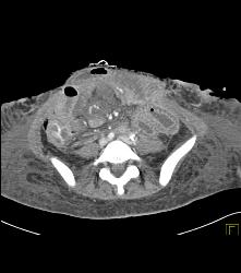 Ischemic Bowel - CTisus CT Scan