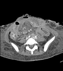 Ischemic Bowel - CTisus CT Scan