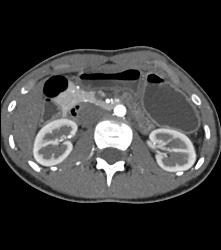 Superior Mesenteric Artery (SMA) Syndrome - CTisus CT Scan