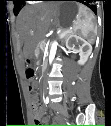 Superior Mesenteric Artery (SMA) Syndrome - CTisus CT Scan