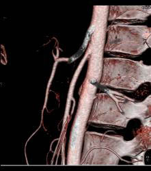 Superior Mesenteric Artery (SMA) Syndrome - CTisus CT Scan