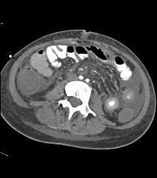 Ischemic Bowel - CTisus CT Scan