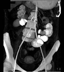 Ischemic Bowel - CTisus CT Scan