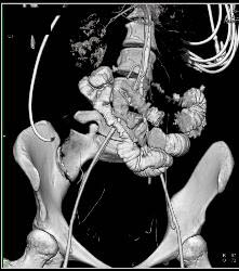 Ischemic Bowel - CTisus CT Scan