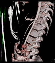 Ischemic Bowel - CTisus CT Scan