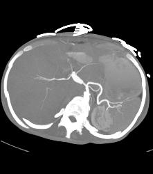 Hepatic Artery Aneurysm - CTisus CT Scan