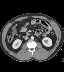 Pneumatosis Segment of Jejunum - CTisus CT Scan