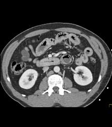 Pneumatosis Segment of Jejunum - CTisus CT Scan