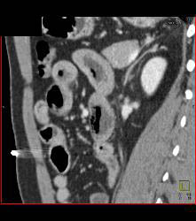 Superior Mesenteric Artery (SMA) Syndrome With Gastric Outlet Obstruction - CTisus CT Scan