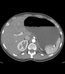 Superior Mesenteric Artery (SMA) Syndrome With Gastric Outlet Obstruction - CTisus CT Scan