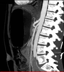 Superior Mesenteric Artery (SMA) Syndrome With Gastric Outlet Obstruction - CTisus CT Scan