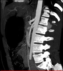 Superior Mesenteric Artery (SMA) Syndrome With Gastric Outlet Obstruction - CTisus CT Scan