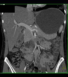 Sma syndrome что