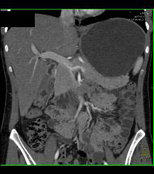 Superior Mesenteric Artery (SMA) Syndrome With Gastric Outlet Obstruction - CTisus CT Scan