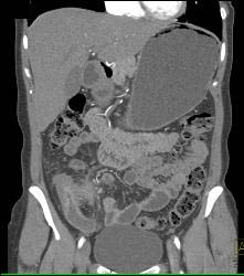 Superior Mesenteric Artery (SMA) Syndrome With Gastric Outlet Obstruction - CTisus CT Scan