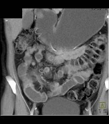 Superior Mesenteric Artery (SMA) Syndrome With Gastric Outlet Obstruction - CTisus CT Scan