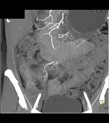 Crohn's Disease - CTisus CT Scan