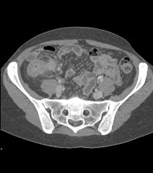 Crohn's Disease - CTisus CT Scan