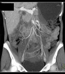 Crohn's Disease - CTisus CT Scan