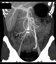 Crohn's Disease - CTisus CT Scan