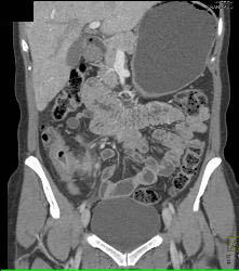 Crohn's Disease - CTisus CT Scan