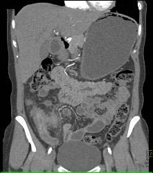 Crohn's Disease - CTisus CT Scan