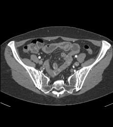 Subtle Multiple Carcinoid Tumors in Small Bowel Show Best on 3D MIP - CTisus CT Scan