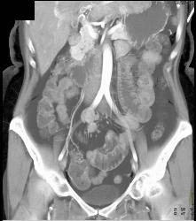 Subtle Multiple Carcinoid Tumors in Small Bowel Show Best on 3D MIP - CTisus CT Scan