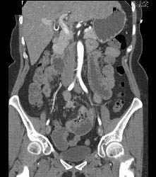 Subtle Multiple Carcinoid Tumors in Small Bowel Show Best on 3D MIP - CTisus CT Scan