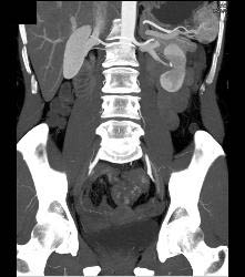 Subtle Multiple Carcinoid Tumors in Small Bowel Show Best on 3D MIP - CTisus CT Scan