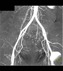 Subtle Multiple Carcinoid Tumors in Small Bowel Show Best on 3D MIP - CTisus CT Scan