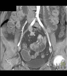 Subtle Multiple Carcinoid Tumors in Small Bowel Show Best on 3D MIP - CTisus CT Scan