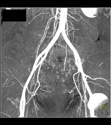 Subtle Multiple Carcinoid Tumors in Small Bowel Show Best on 3D MIP - CTisus CT Scan