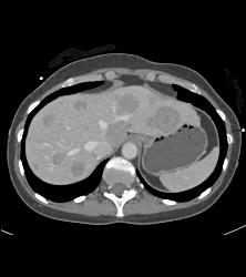 Metaststic Melanoma - CTisus CT Scan