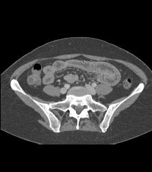 Metaststic Melanoma - CTisus CT Scan