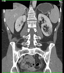 Metaststic Melanoma - CTisus CT Scan