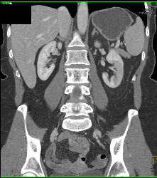 Carcinoid Tumor in Ileum - CTisus CT Scan