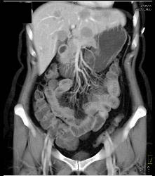 Carcinoid Tumor in Ileum - CTisus CT Scan