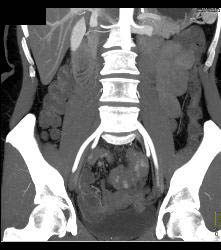 Carcinoid Tumor in Ileum - CTisus CT Scan