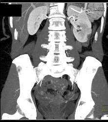 Carcinoid Tumor in Ileum - CTisus CT Scan