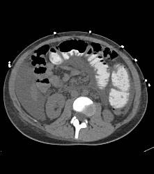 B-cell Lymphoma in Ileum - CTisus CT Scan