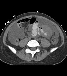 B-cell Lymphoma in Ileum - CTisus CT Scan