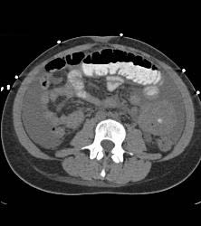 B-cell Lymphoma in Ileum - CTisus CT Scan