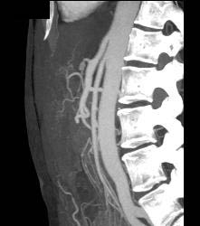 Superior Mesenteric Artery (SMA) Syndrome - CTisus CT Scan