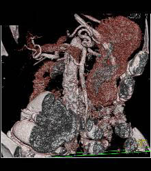 Superior Mesenteric Artery (SMA) Syndrome - CTisus CT Scan