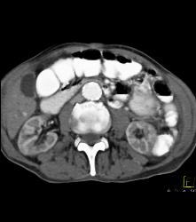 Superior Mesenteric Artery (SMA) Syndrome - CTisus CT Scan