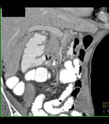 Superior Mesenteric Artery (SMA) Syndrome - CTisus CT Scan