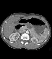 Desmoid Tumor - CTisus CT Scan