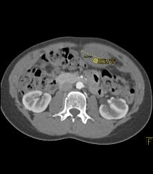 Desmoid Tumor - CTisus CT Scan